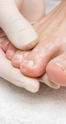 5 Essential Treatments for Athlete’s Foot
