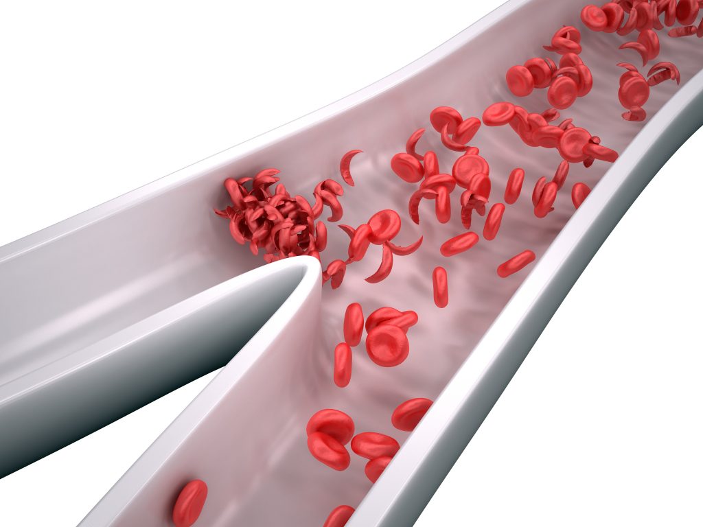 sickle-cell-crisis-overview-facts-types-symptoms-watsons-health-my