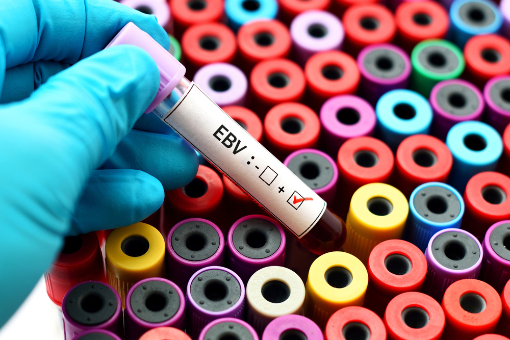 Epstein-barr Virus (EBV)