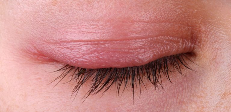 EYELID INFLAMMATION OR BLEPHARITIS