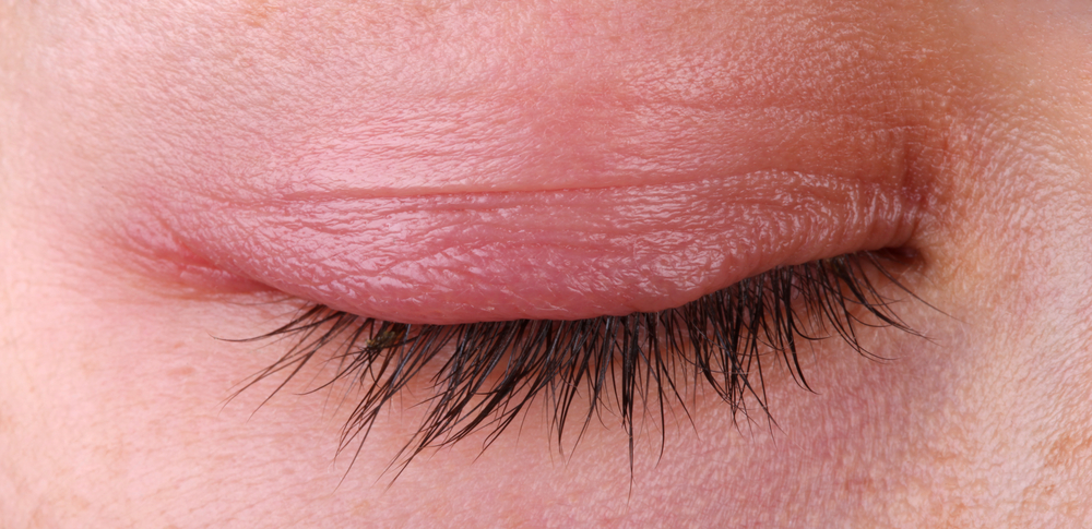 EYELID INFLAMMATION