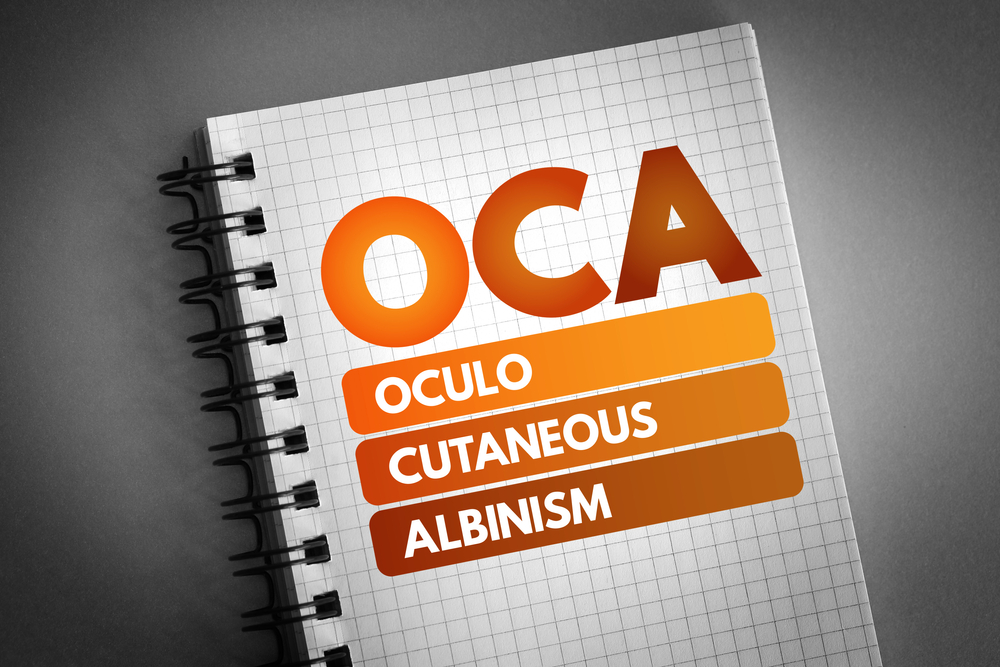 OCULOCUTANEOUS ALBINISM